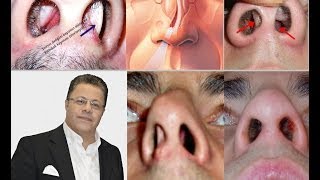Download Burun Tıkanıklığı, Kıkırdak Eğrilikleri, Burun Etleri Nedenleri Ve Tedavileri*op Video MP3 Burun Tıkanıklığı, Kıkırdak Eğrilikleri, Burun Etleri Nedenleri Ve Tedavileri*op