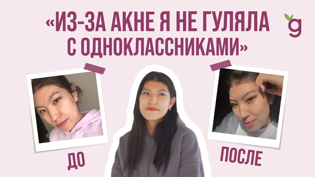 Избавиться от акне навсегда РЕАЛЬНО! - YouTube