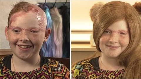 11-Year-Old Girl Scalped From Carnival Ride Gets W...