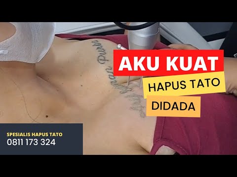 Hapus Tato di payudara keluar suara yang meresahkan #hapustato #tattooremoval