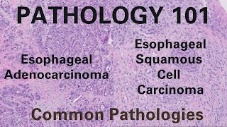 Esophageal Adenocarcinoma and Squamous Cell Carcinoma | Pathology 101| GI Pathology