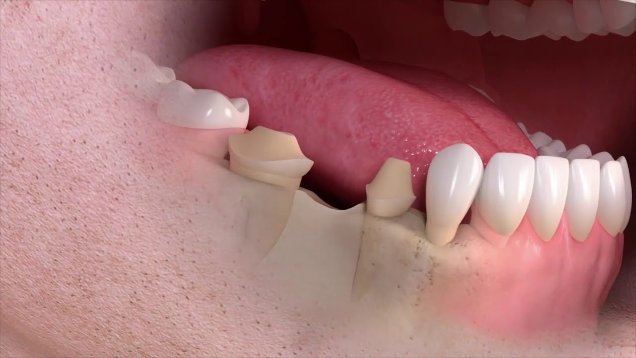 Ocean Dental Cancun | Save up 70% In Dental Bridges in Mexico