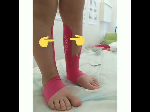 тейпирование вальгусной стопы. тейпирование варусной стопы. тейпирование примвальгусной деформации стопы. тейпирование в педиатрии при вальгусной деформации. тейпирование вальгусной стопы.