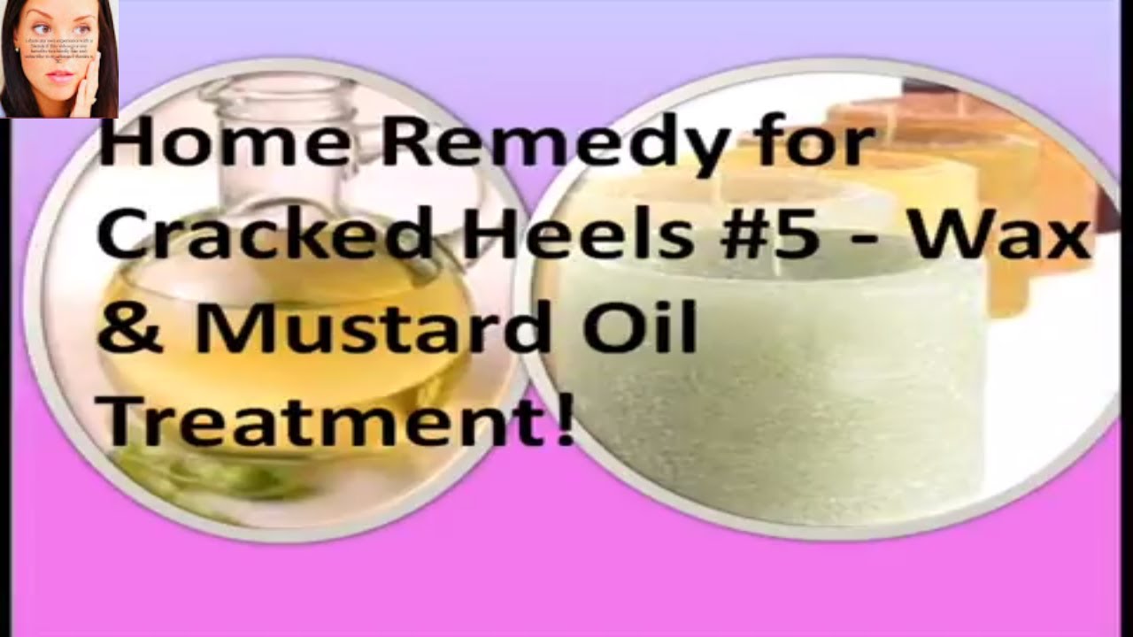 Home Remedies for Treating and Preventing Cracked Heels — Steemit