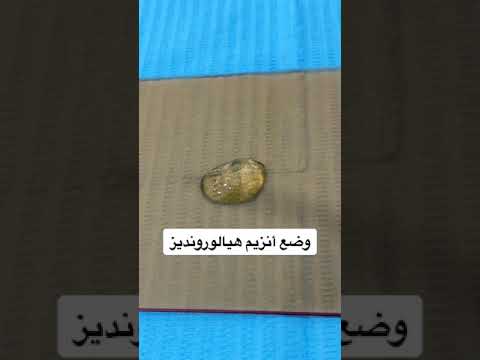 كيفية إذابة الفيلر  