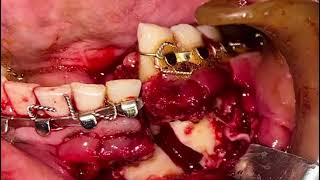 Open reduction and internal fixation - Oral and Maxillofacial Surgery - HIDS, Paonta Sahib (Sirmaur)