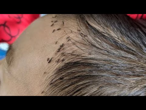 KUTU RAMBUT ANAK KECIL TERBANYAK || cara membersihkan kutu rambut