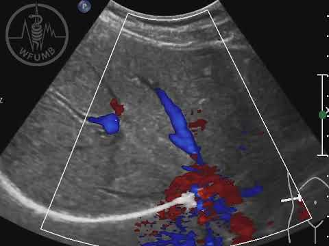 WFUMB Course Book: Abdominal Vessels and Portal Vein System Chapter 11 - video 11.5