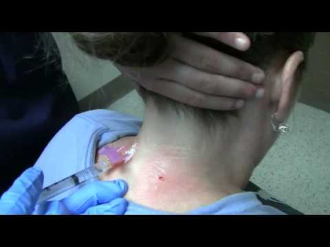 Video Nerve Pain In Neck Head And Face
