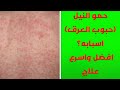 حمو النيل حبوب العرق الطفح الحراري اسبابه و افضل و اسرع طرق علاج حمو النيل علاج حمو النيل 
