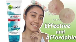 Acne Cleanup | Step By Step | Siddharth Nigam | Cutis Skin Solution