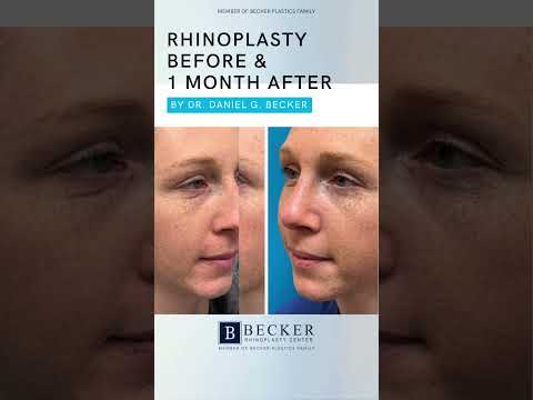 Video thumbnail: No More Droopy Tip When She Smiles 😊👃 | Rhinoplasty by Dr. Becker · Becker Rhinoplasty Center