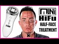 Home Ultherapy Mini Hifu Tutorial | High Intensity Focused Ultrasound Before & After