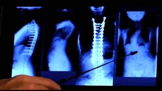 The Catherine Ross Story - From Patient to Engineer