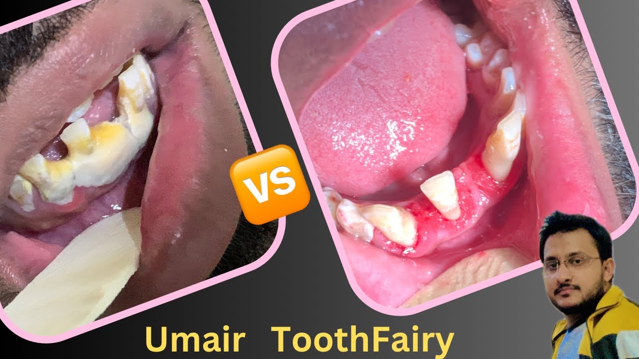Calculus effect on gums(treatment Scaling ) #dental#dentistry#smile# ...