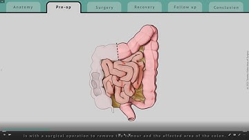 Right Hemicolectomy explained | What patients can expect | TVASurg