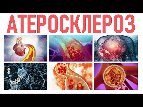 ЛЕЧЕНИЕ АТЕРОСКЛЕРОЗА | Диагностика и классификация атеросклероза