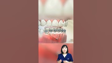 Điều trị khớp cắn sâu trong chỉnh nha | Dr Anh Thư