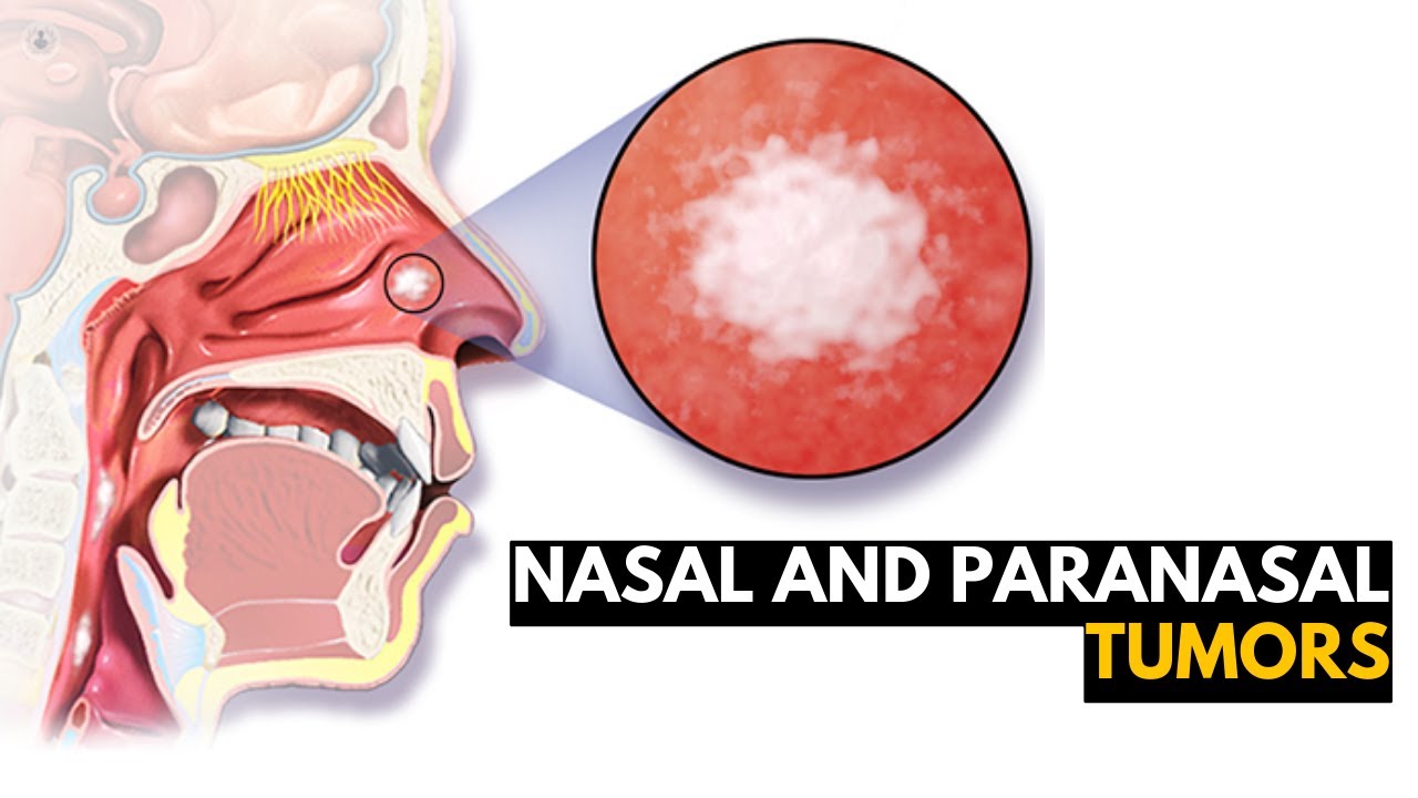 Nasal And Paranasal Tumors, Causes, Signs And Symptoms, Diagnosis And Treatment.