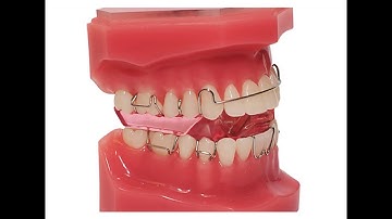 Twin Block for Correction  Small Lower Jaw, Treatment of Class II by Twin Block,Functional Appliance