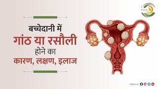 What are Fibroids बच च द न म ग ठ य रस ल ह न क क 