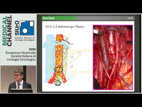 Video: Trattamento Del Carcinoma A Cellule Squamose Sopraglottiche In Fase Iniziale: Meta-analisi Che Confronta La Chirurgia Primaria Rispetto Alla Radioterapia Primaria