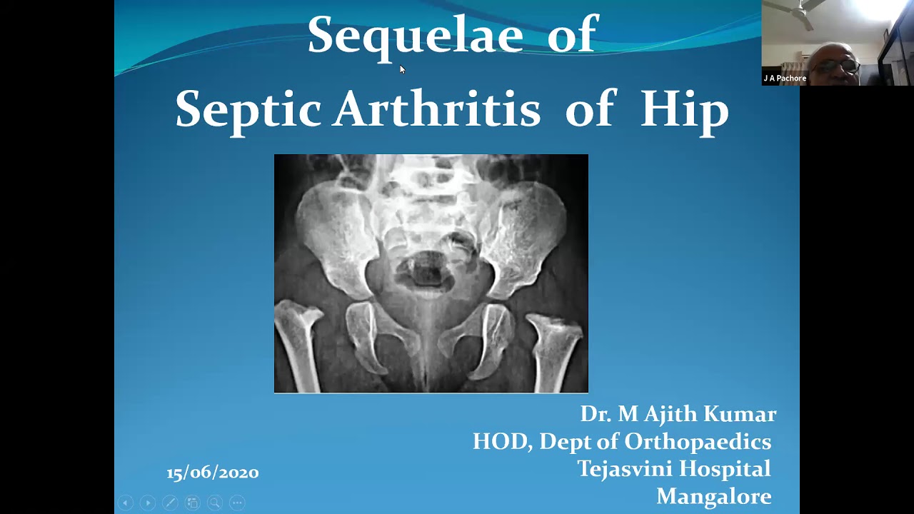 TO PASS DNB/MS ORTHOPAEDICS CASE 94 SEQUELAE OF SEPTIC ARTHRITIS OF