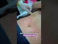 reshape cold plasma for stretch marks