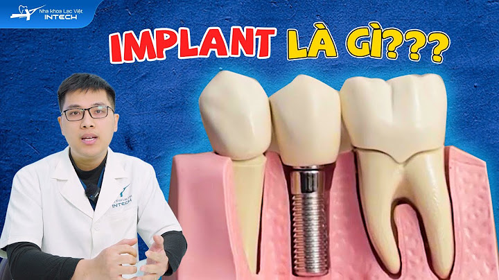 Trồng răng bằng phương pháp implant là gì năm 2024