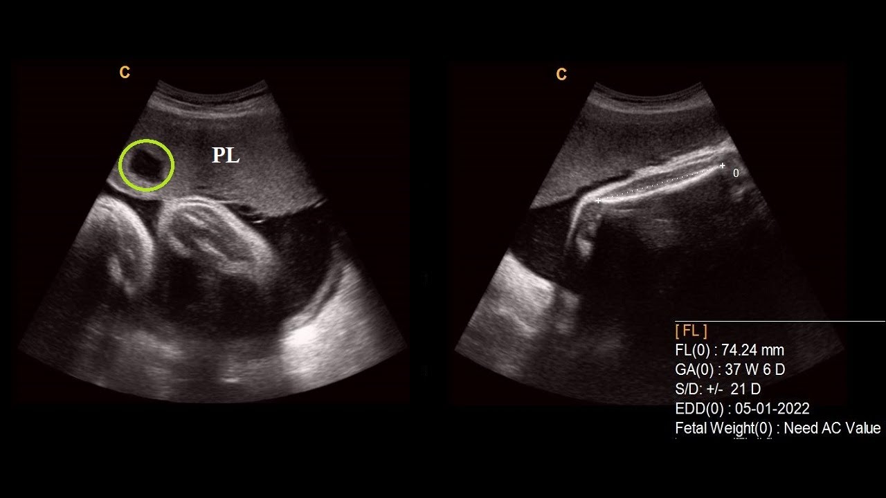 Multiple placental lakes 38 weeks pregnancy Pregnancy Profile