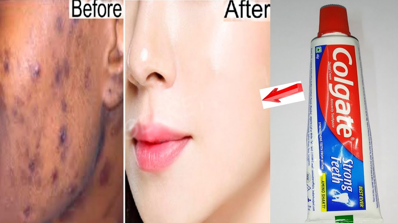 Remove Pimples With Toothpaste How To Remove Pimples Using Toothpaste
