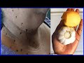 Garlic in 3 days remove skin tags home remedies / best way to remove skin tags fast in 3 days