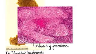 TB vs Lymphoma: Compare and Contrast Histopathology Lymph Node Tuberculosis
