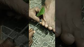 Foot Corn Treatment By