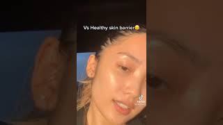 FROM ACNE TO CLEAR SKIN JOURNEY |SKINCARE TIKTOK #SHORTS screenshot 5