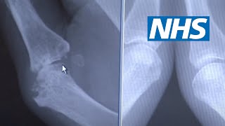 Rheumatoid arthritis | NHS