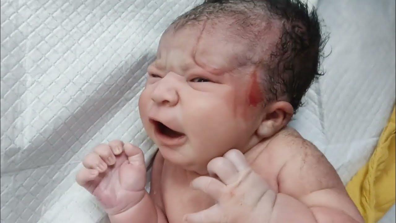 big-forehead-mark-of-forceps-of-chunky-newborn-baby-immediately-after