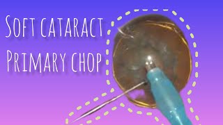 Soft cataract - primary chop screenshot 5