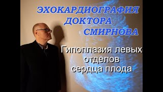 3. Гипоплазия Левых Отделов Сердца Плода