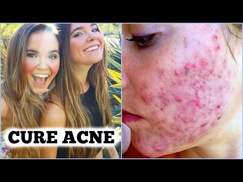 CYSTIC ACNE CURED FOR GOOD- Introducing Dr. McDougall