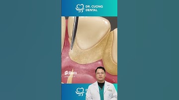 Bí Quyết Sở Hữu Nụ Cười Rạng Rỡ Chỉ Sau Một Lần Lấy Cao Răng |Dr Cường Official
