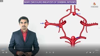 Berry aneurysms (saccular) - Most common sites, Symptoms, Diagnosis and Pathology