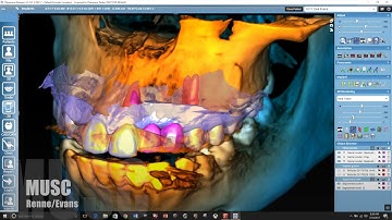 fully guided implant  Planmeca Romexis emerald