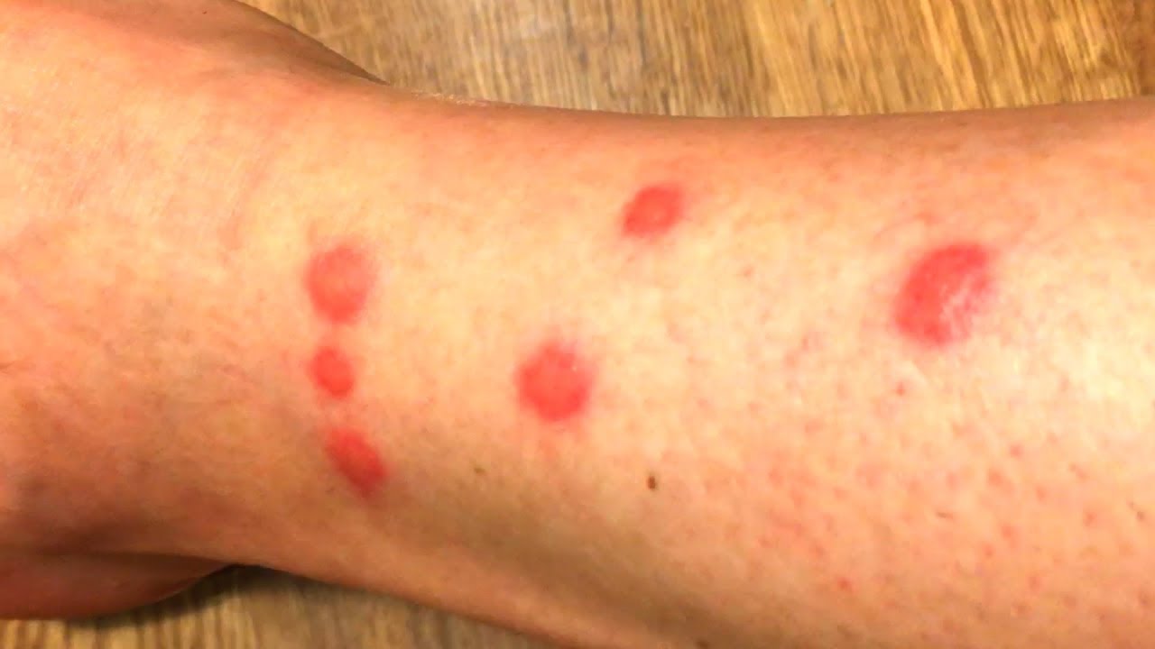 閲覧注意 この寒い季節に足首を蚊か何かの虫に刺された Youtube