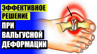 Как растет косточка на ноге 🤥