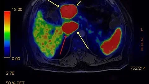 Pancreatic neuroendocrine tumors (PNETs) - Mayo Clinic