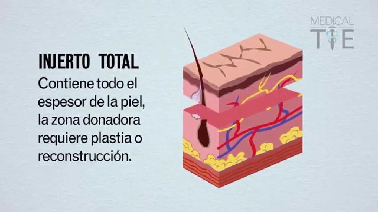 MEJOR VIDEO EXPLICATIVO Injertos de piel y colgajos YouTube MEJOR VIDEO EXPLICATIVO Injertos de piel y colgajos YouTube