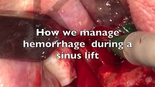 Download lagu How We Manage Hemorrhage During A Sinus Lift Mp3 Video Mp4