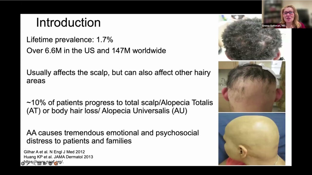 The connection between allergies, eczema, and alopecia areata: Implications for new treatments