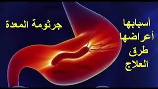 OTC - جرثومة المعدة (الأسباب - الأعراض - العلاج)  - ميكروب المعده - H.pylori - البكتيريا الحلزونيه.